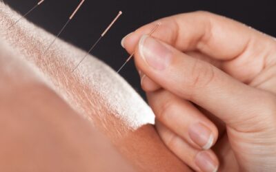 Medical acupuncture: what it is and what are the main benefits?