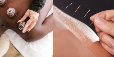 Cupping Therapy vs Dry Needling: which one you should choose