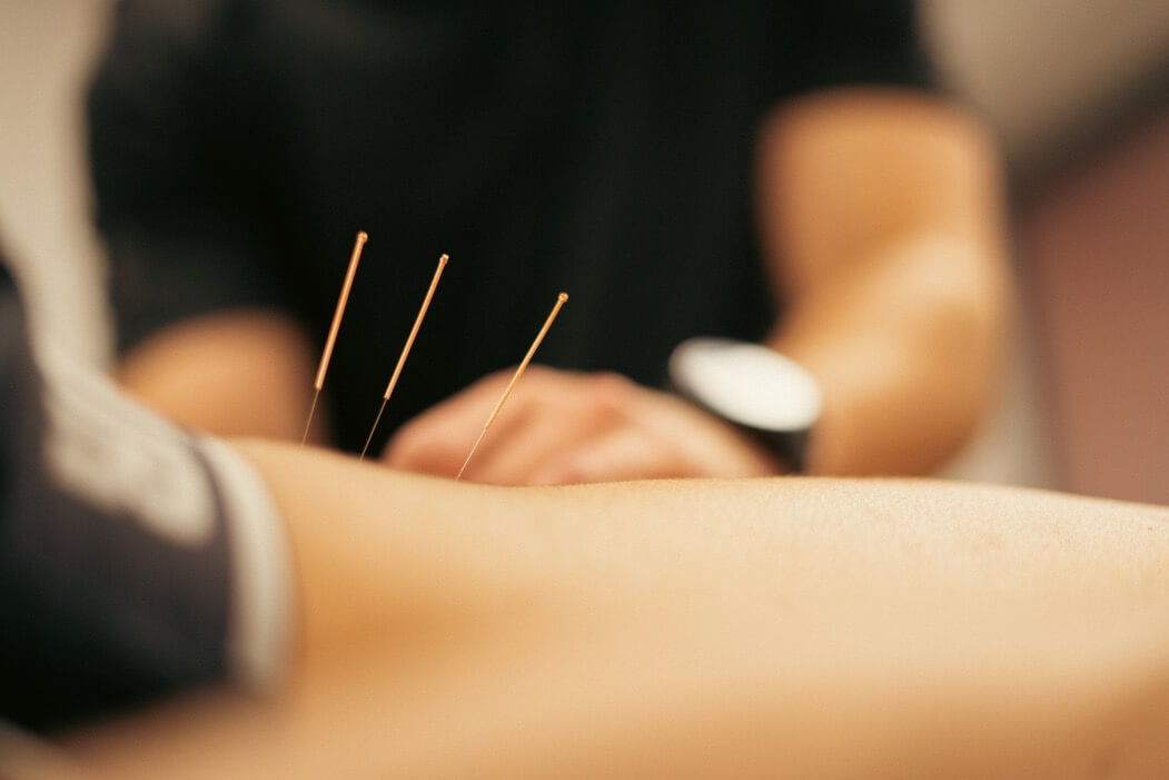 Acupuncture session at our physiotherapy clinics in Bradford & Leeds