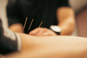 Medical acupuncture service