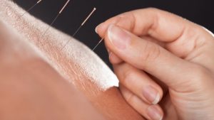 Medical acupuncture: what it is and what are the main benefits?