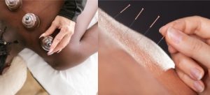 Cupping Therapy VS Medical Acupuncture